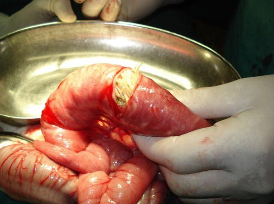 Nematodos en el intestino humano.
